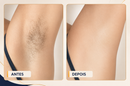 Depilador a Laser LumiSkin Pro™ | Remoção de Pelos com Tecnologia IPL